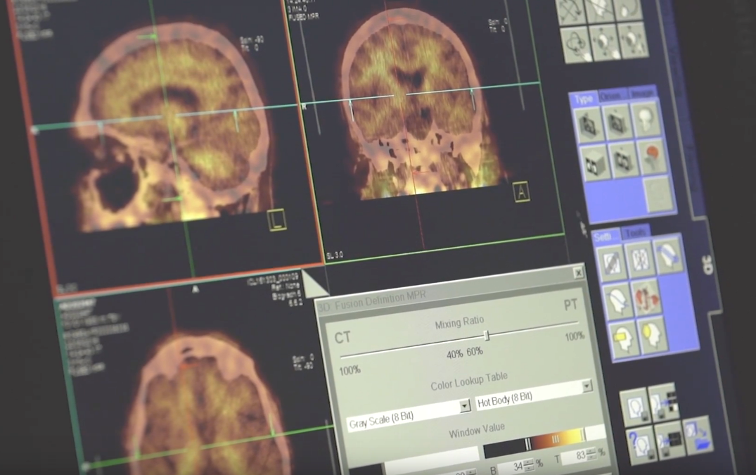 What can PET scans tell us about dementia? Alzheimer's Society